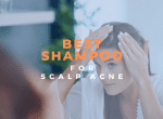 best shampoo for scalp acne image