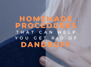 homemade procedures for dadruff image