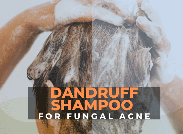 Best Dandruff Shampoo for Fungal Acne